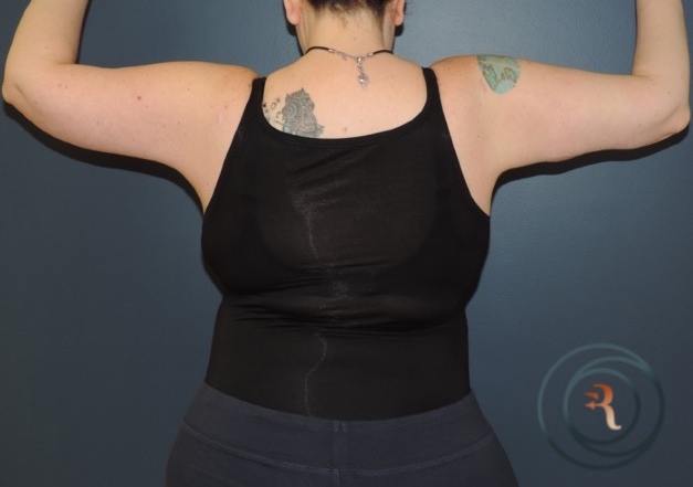 After — Arm Lift