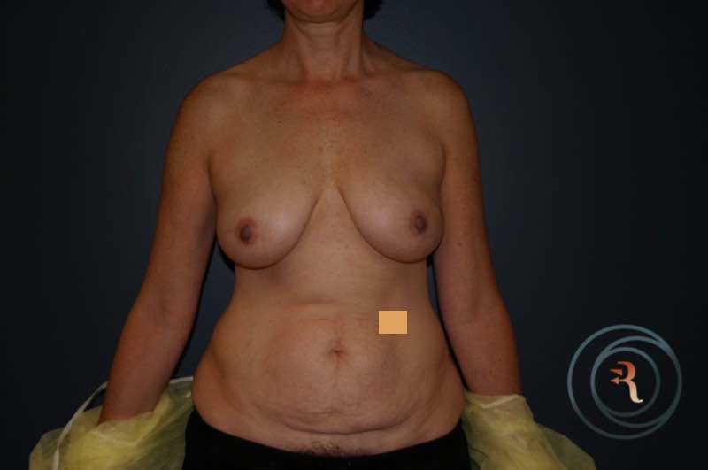 Before — Breast Reconstruction
