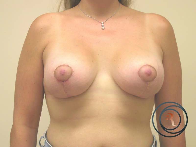 Breast Lift after