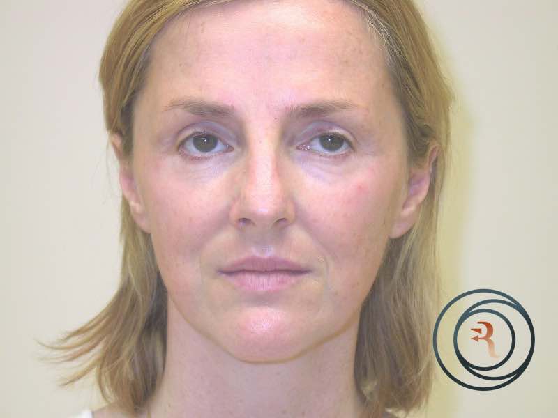 Rhinoplasty before
