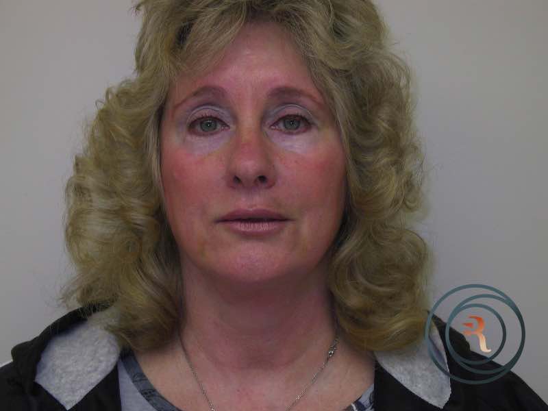 Brow Lift after