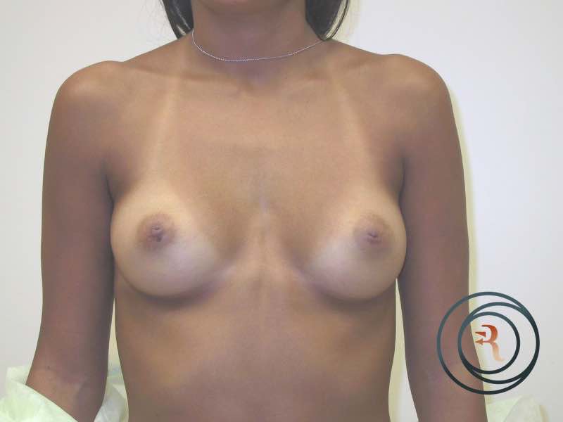 Breast Augmentation before