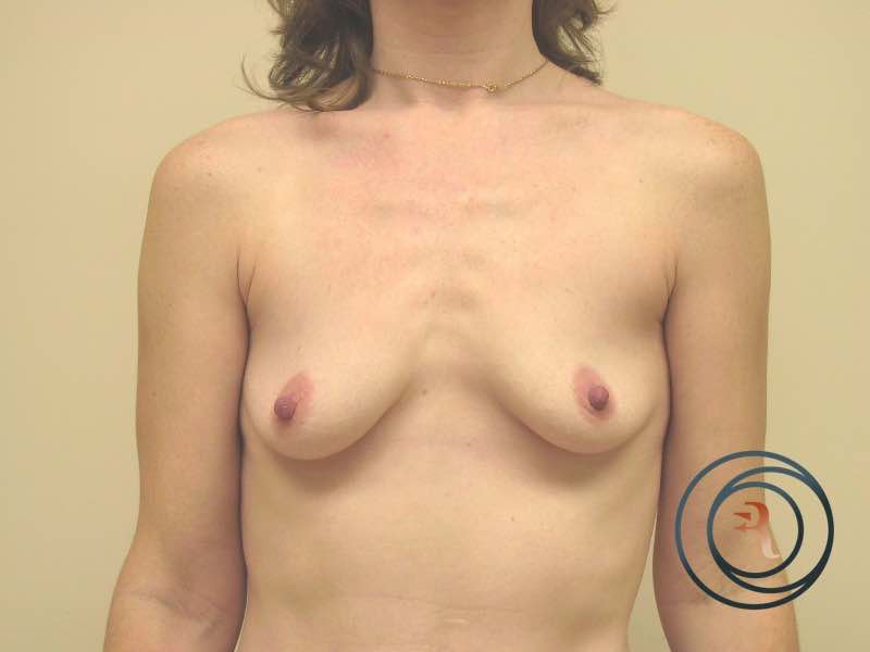 Before — Breast Augmentation