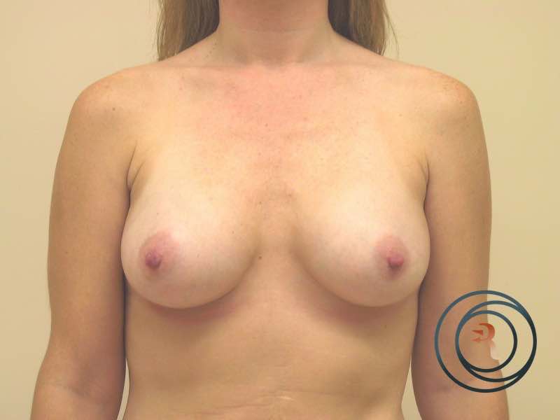 After — Breast Augmentation