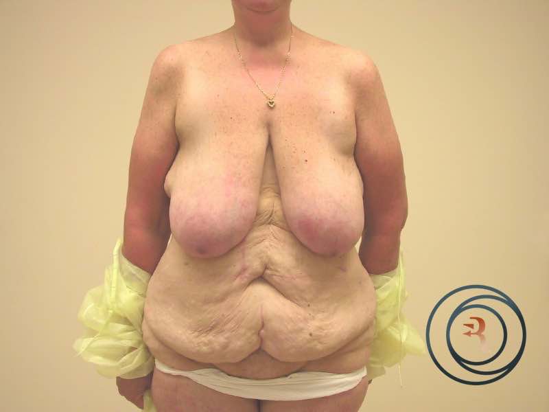 Breast Reduction, Abdominoplasty, Liposuction before