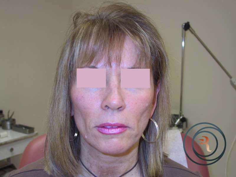 Ear Surgery (Otoplasty) before