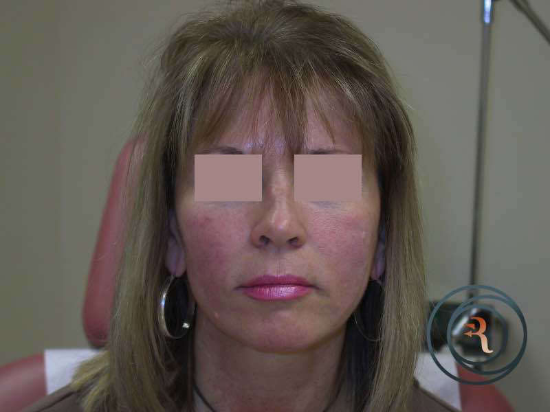 Ear Surgery (Otoplasty) after