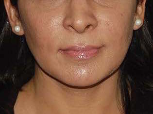 Lip Lift before