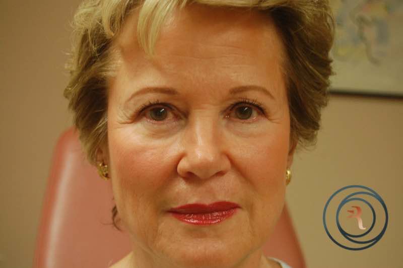 Ear Surgery (Otoplasty) after