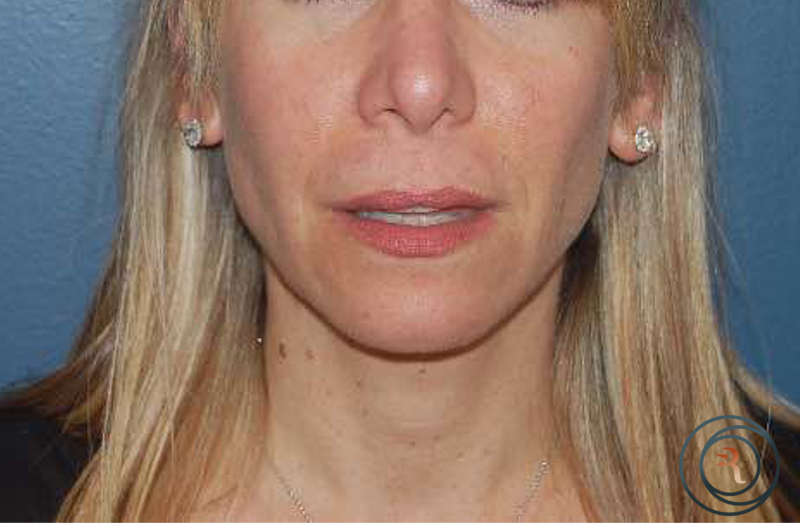 Lip Lift before