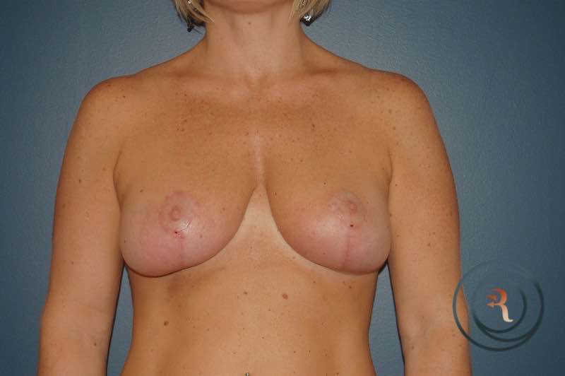 Breast Lift after