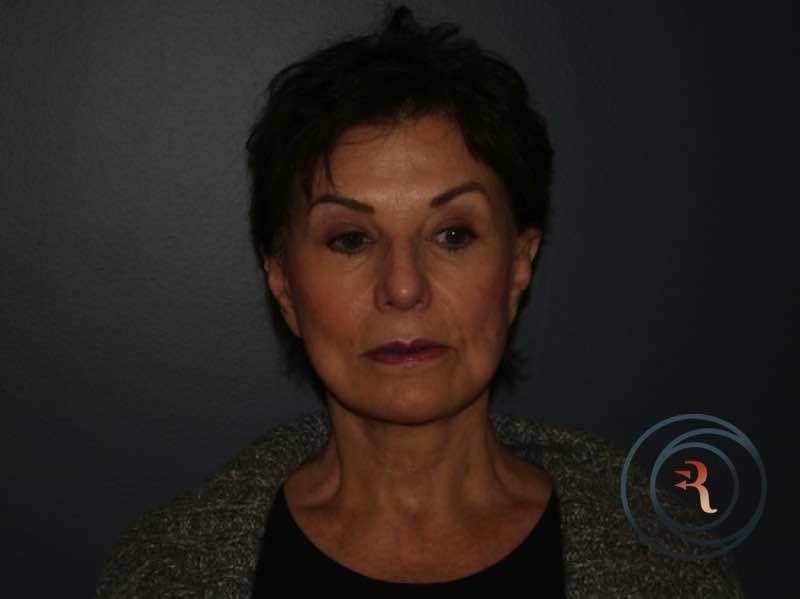 Facelift, Fat Grafting before