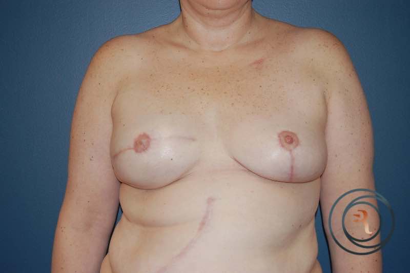 After — Left Breast Lift, Right Breast Reconstruction