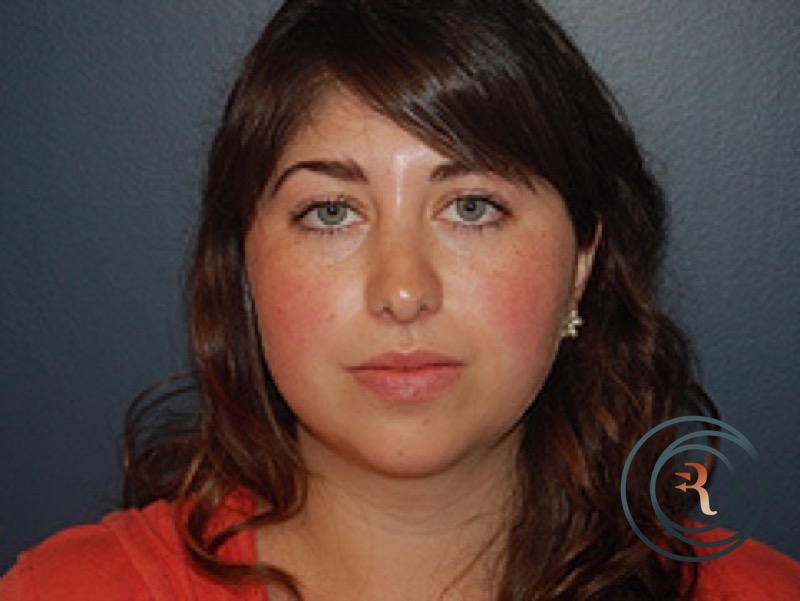 Rhinoplasty after