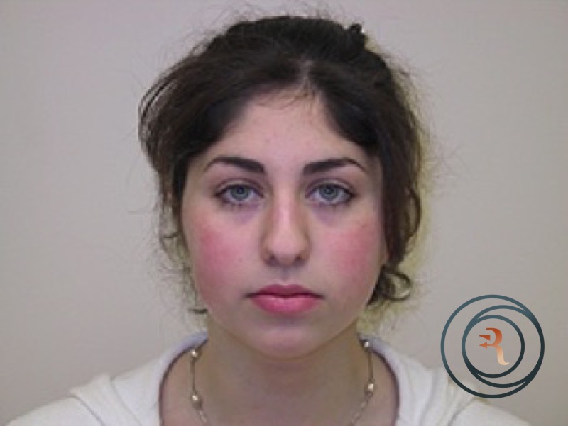 Rhinoplasty before