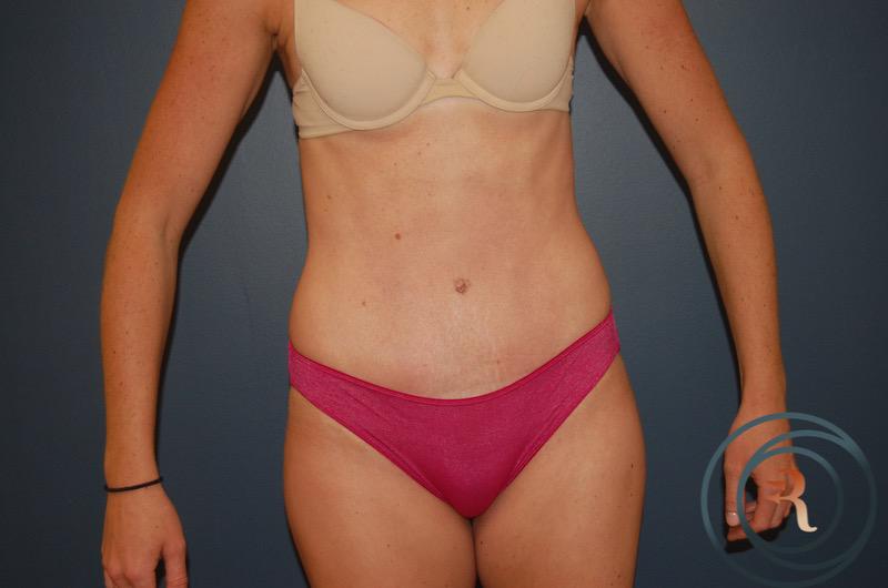 After — Abdominoplasty