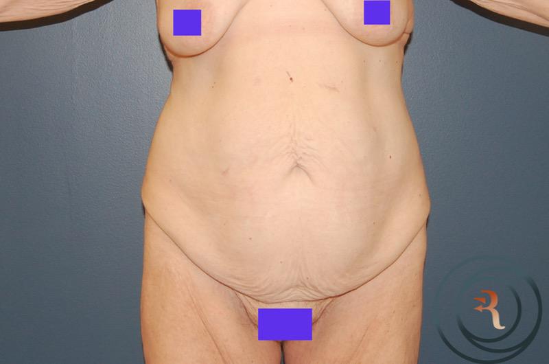 Before — Abdominoplasty