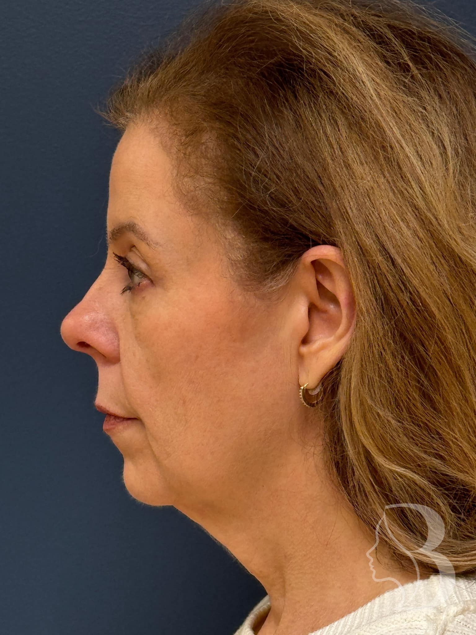 Facelift with fat transfer after &mdash; lateral view showing restored cheek projection