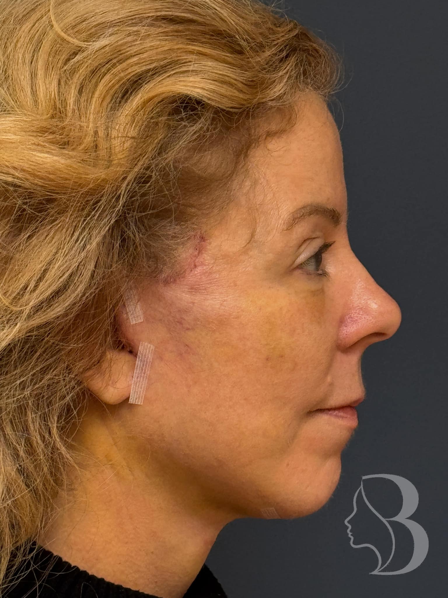 Facelift before &mdash; lateral view showing midface descent and hollow cheeks