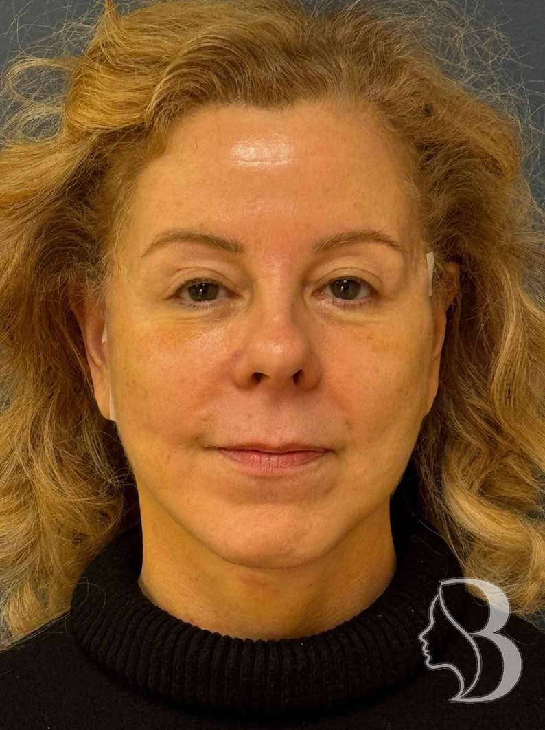 Deep plane face and neck lift after
