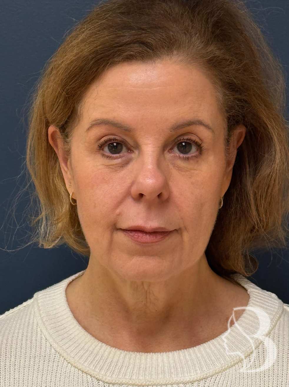Deep plane face and neck lift before