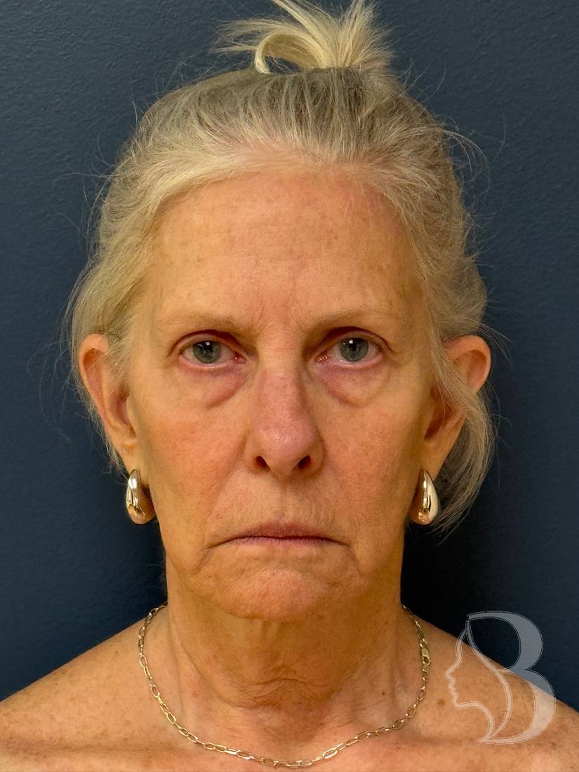 Deep plane face and neck lift, brow lift, blepharoplasty, fat transfer before