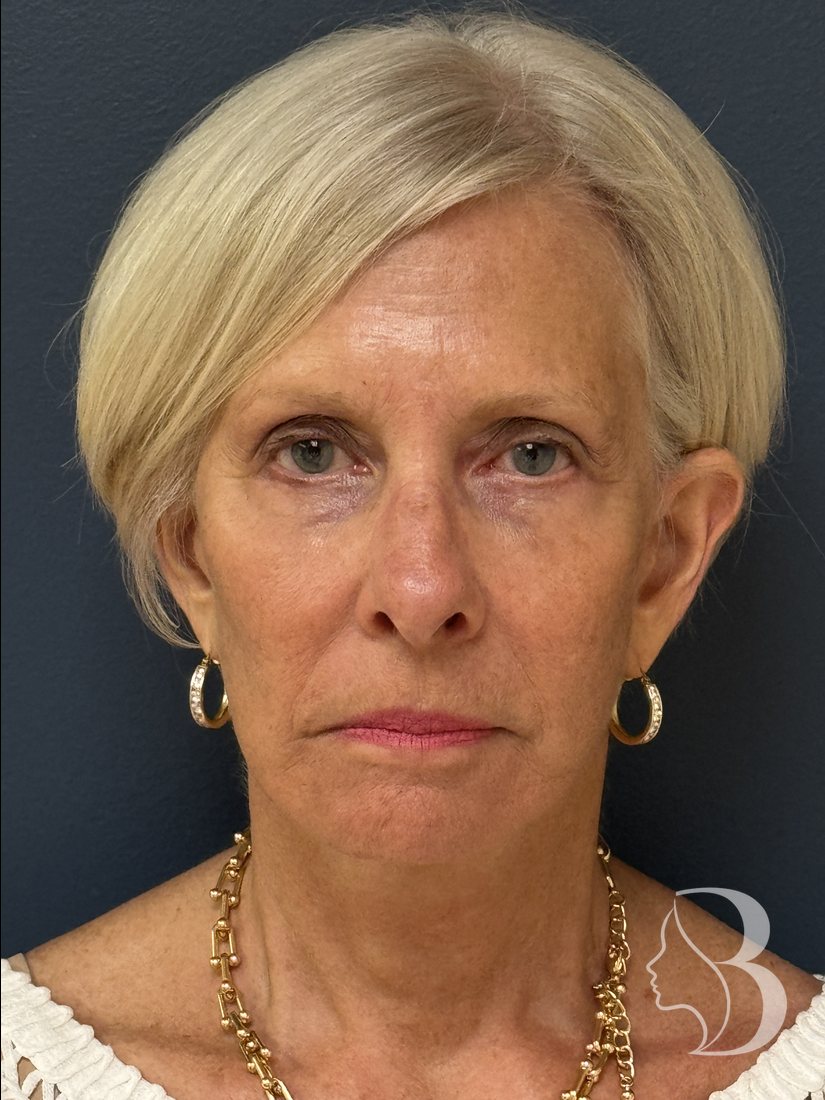 Deep plane face and neck lift, brow lift, blepharoplasty, fat transfer after