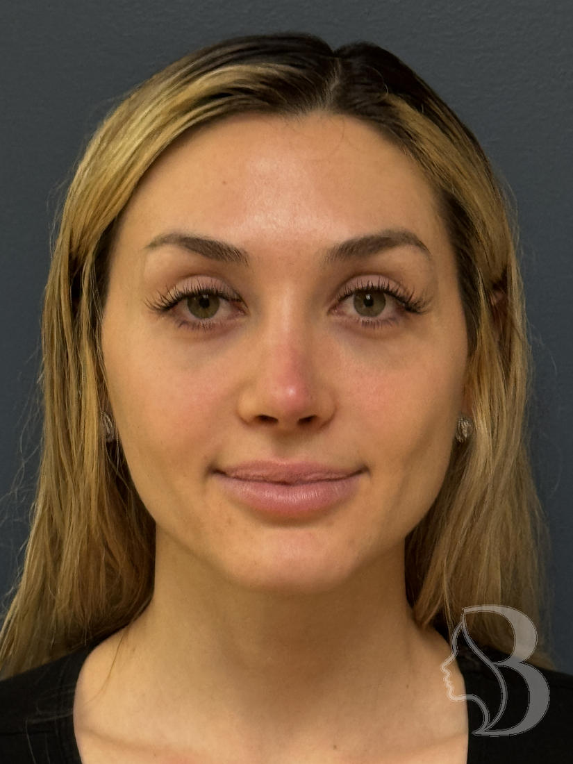 Open rhinoplasty after