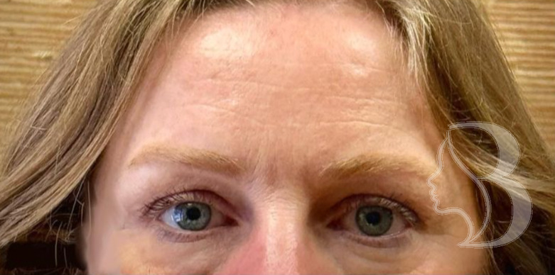 Dysport - Brow Lift after
