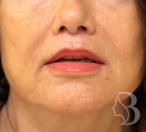 Lip Lift after