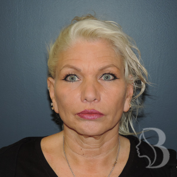 Face & Neck Lift, Lower Blepharoplasty before