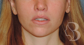 Lip Lift before