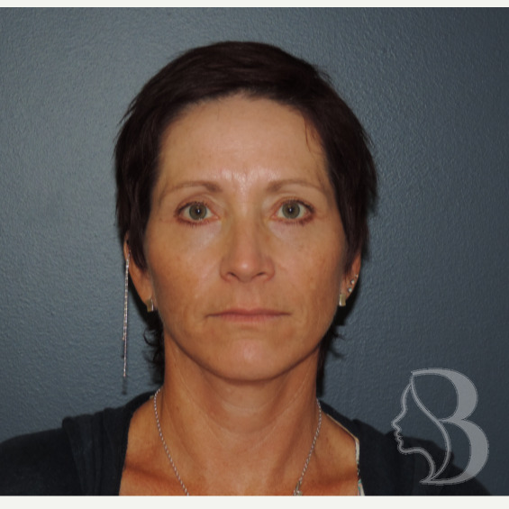 Face & Neck Lift, Upper & Lower Blepharoplasty after