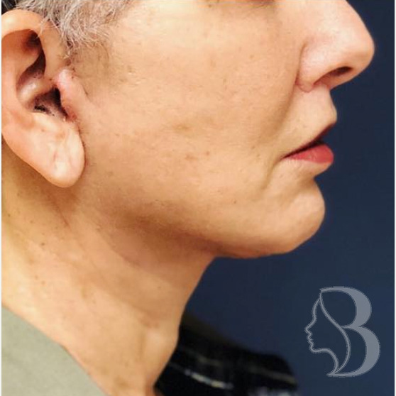 Lip Lift, Facelift, Neck Lift after
