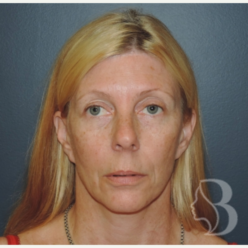 Lip Lift before