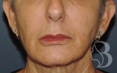 Lip Lift before