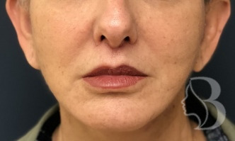 Lip Lift after