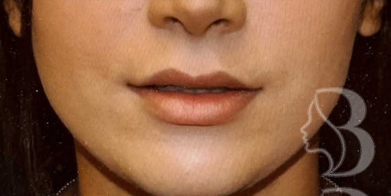 Lip Lift before