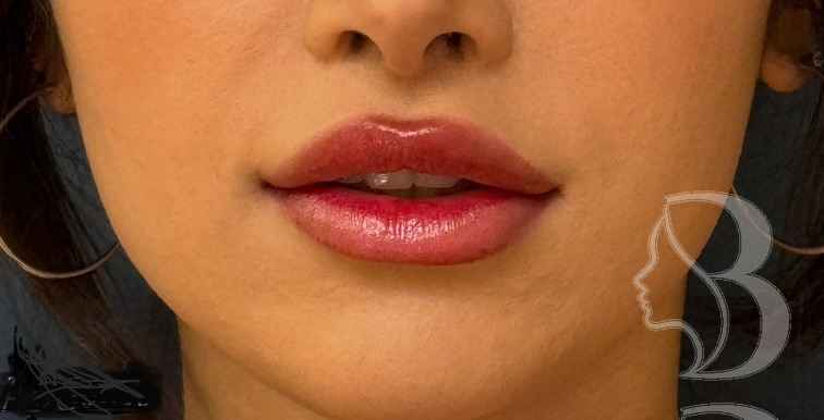 Lip Lift after