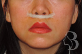 Lip Lift after