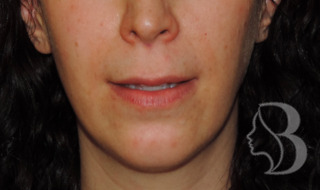 Lip Lift before