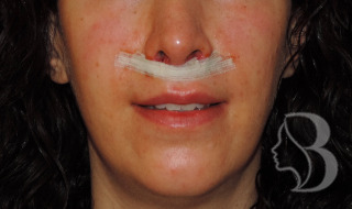 Lip Lift after