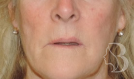Lip Lift before