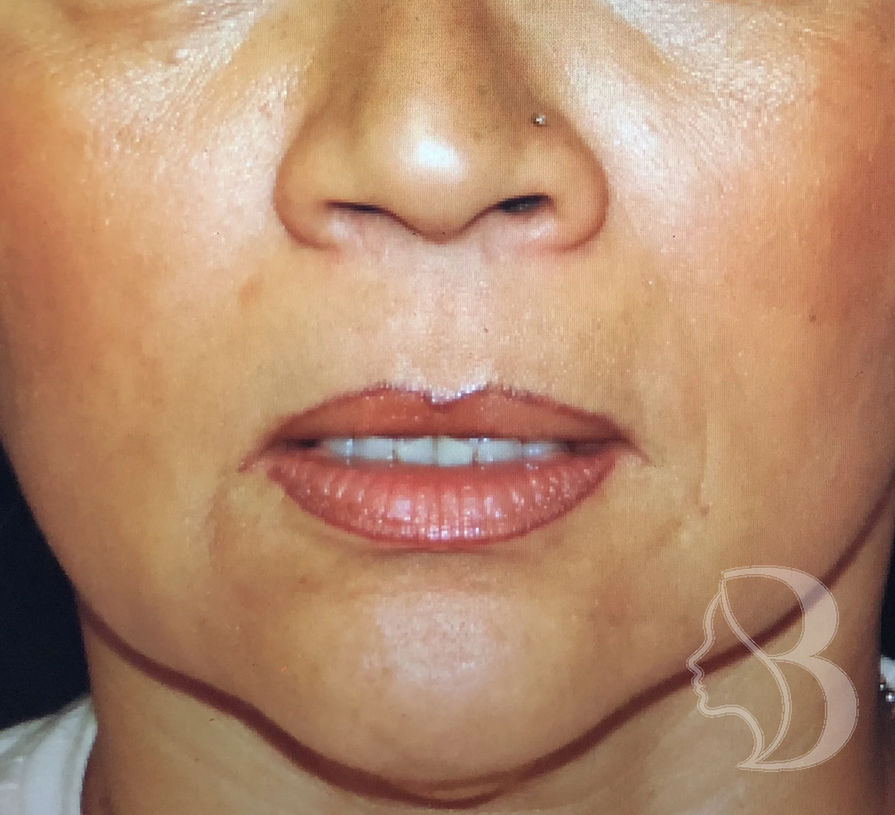 Lip Lift before