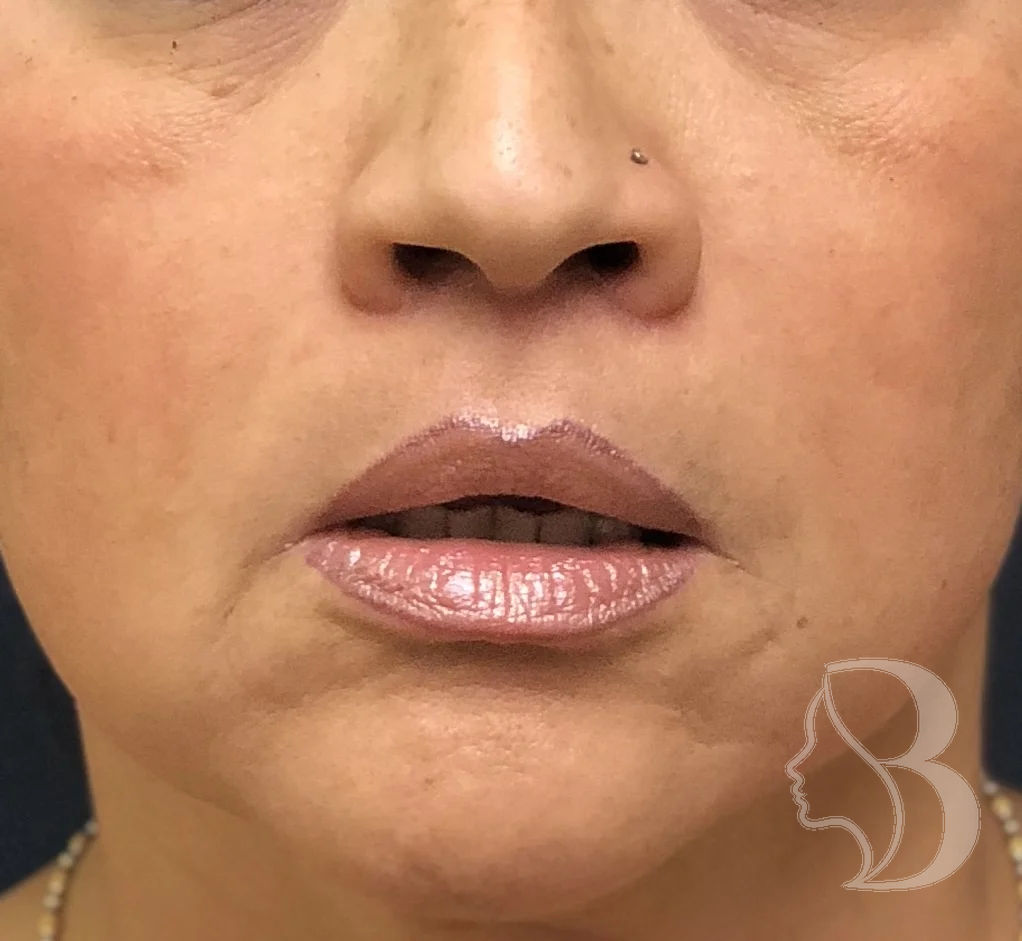 Lip Lift after
