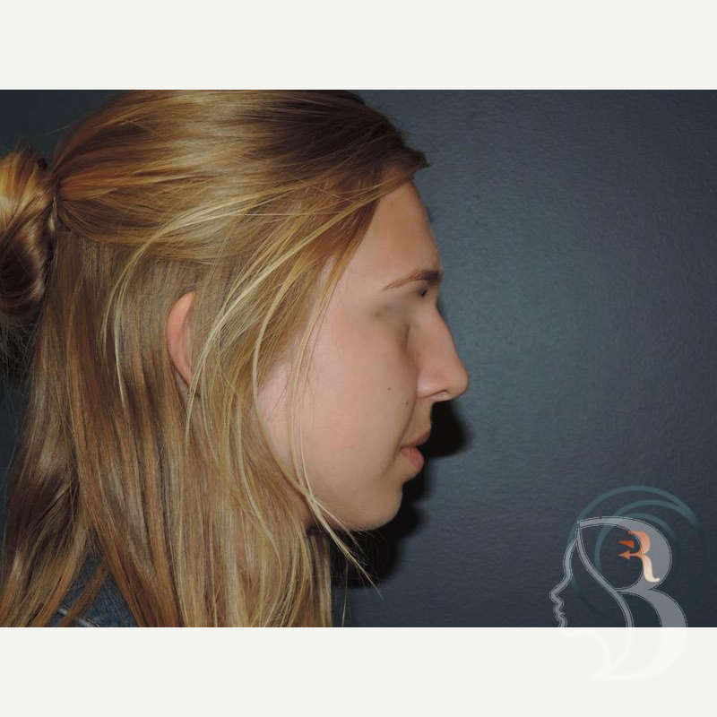 Rhinoplasty, Chin Implant before