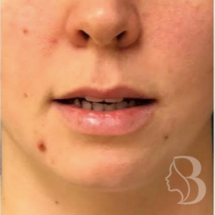 Lip Lift before