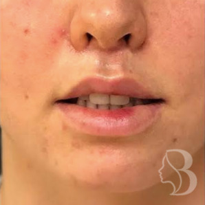 Lip Lift after