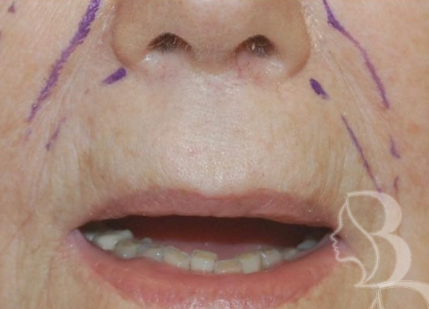 Lip Lift before