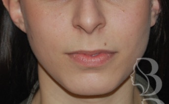 Lip Lift before